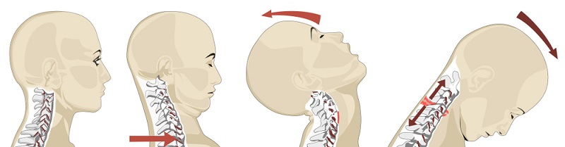 neck injury attorney