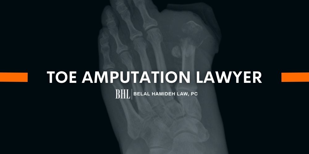 Toe Amputation Injury Lawyer in Long Beach | Belal Hamideh Law