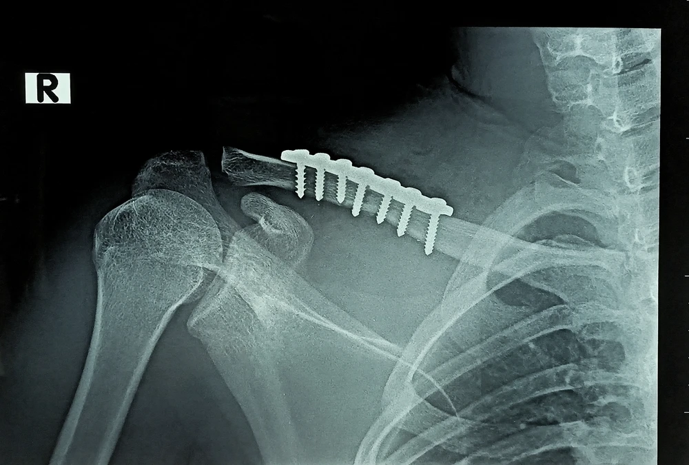 irvine truck accident lawyer